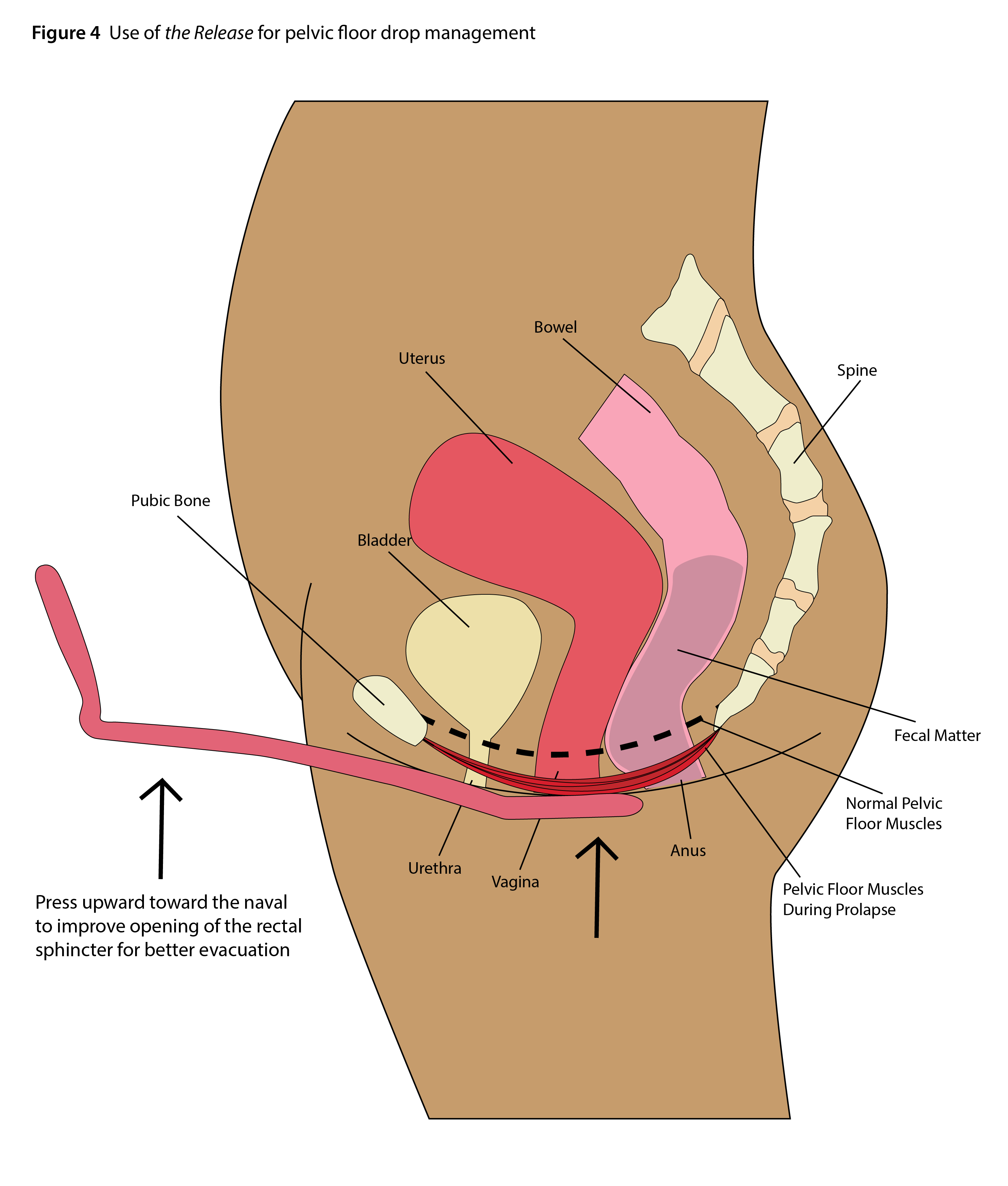 PHYSIO Bowel Movement 101: How to Relax Anus, STOP Straining and RELIEVE  Pelvic Pain 