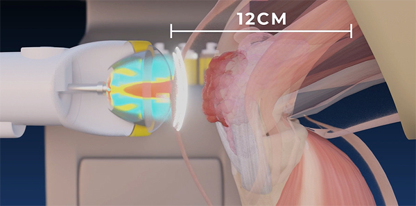 SoftWave utilizes acoustic parallel waves.