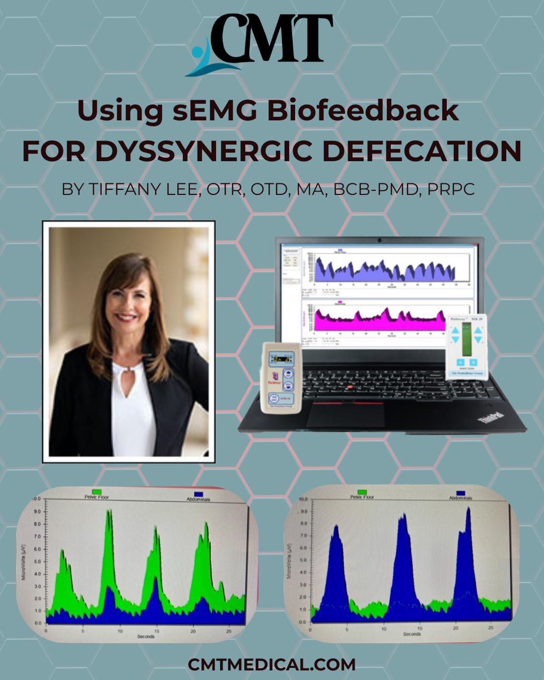 Using sEMG Biofeedback for Dyssynergic Defecation